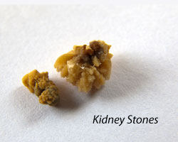 Notice the irregular shape of these kidney stones